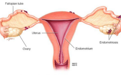 Endometriosis: Eliminate The sharp Abdominal Pain